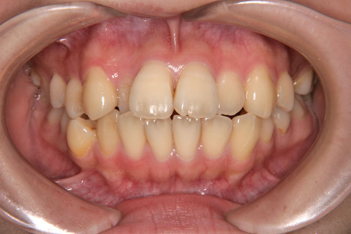 症例紹介 矯正歯科 大阪 ほてい矯正歯科