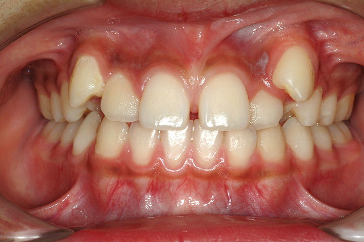 症例紹介 矯正歯科 大阪 ほてい矯正歯科
