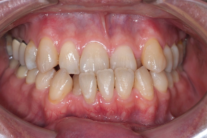 症例紹介 矯正歯科 大阪 ほてい矯正歯科